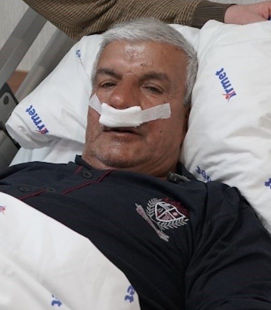 Tekirdağ’ın Saray ilçesinde 65 yaşındaki adamın burnundan 100 gramlık taş
