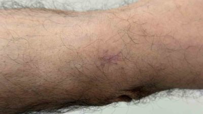Kolunda çıkan yara geçmeyince doktora giden 75 yaşındaki İbrahim Çelik,